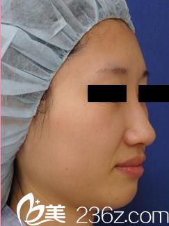 田中真輔隆鼻手術(shù)前 田中真輔隆鼻手術(shù)前