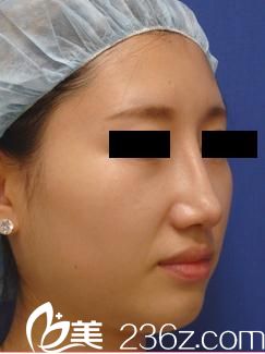 田中真輔隆鼻手術(shù)后 田中真輔隆鼻手術(shù)后