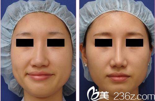 田中真輔隆鼻手術(shù)前后對(duì)比 田中真輔隆鼻手術(shù)前后對(duì)比