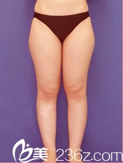 小川英朗吸脂手術(shù)前 小川英朗吸脂手術(shù)前