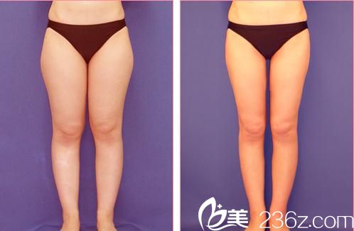 小川英朗吸脂手術(shù)前后對(duì)比 小川英朗吸脂手術(shù)前后對(duì)比