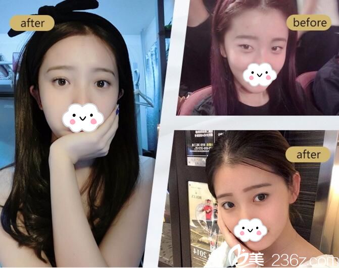 武漢葉子雙眼皮案例 武漢葉子雙眼皮案例