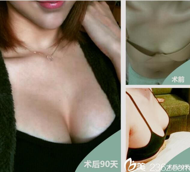 武漢葉子假體豐胸案例 武漢葉子假體豐胸案例