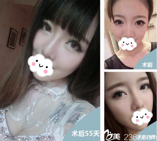 武漢葉子假體隆鼻案例 武漢葉子假體隆鼻案例