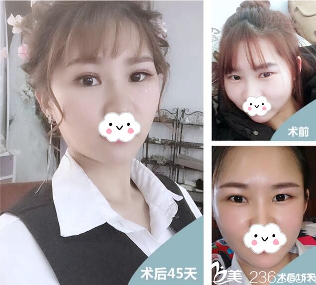 武漢葉子自體脂肪面部填充案例 武漢葉子自體脂肪面部填充案例