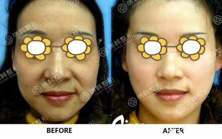 瑞韓面部年輕化真人前后效果對(duì)比