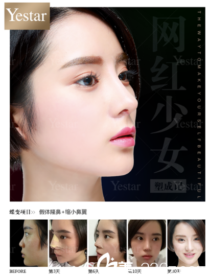 深圳yestar整形醫(yī)院潘華做的鼻綜合隆鼻案例 深圳yestar整形醫(yī)院潘華做的鼻綜合隆鼻案例