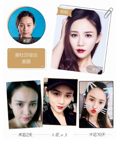 深圳yestar整形潘華做的美杜莎綜合美眼雙眼皮案例 深圳yestar整形潘華做的美杜莎綜合美眼雙眼皮案例