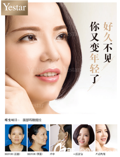 深圳藝星潘華做的面部線雕埋線提升案例 深圳藝星潘華做的面部線雕埋線提升案例