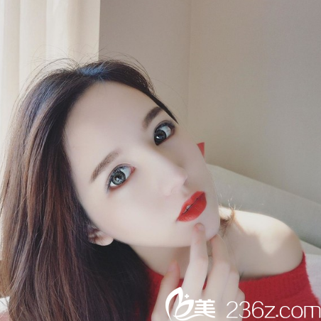 深圳藝星整形潘華醫(yī)生雙眼皮隆鼻案例1個月自拍 深圳藝星整形潘華醫(yī)生雙眼皮隆鼻案例1個月自拍