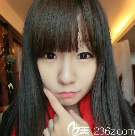 來深圳藝星整形的術(shù)前照片 來深圳藝星整形的術(shù)前照片