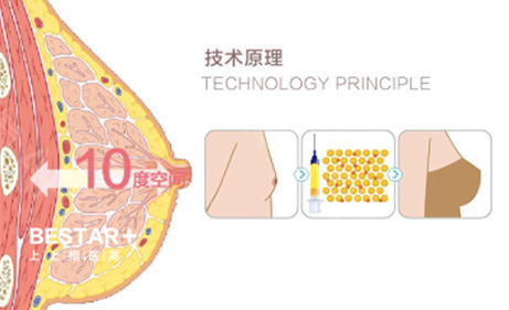 維秘明星藝術(shù)豐胸技術(shù)原理示意圖