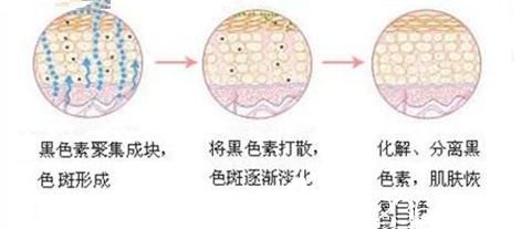 調Q開關翠綠寶石激光原理