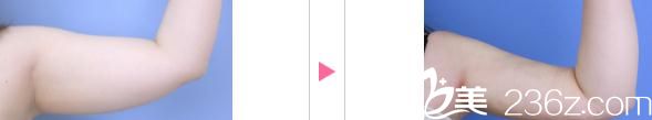 中村大輔手臂吸脂手術(shù)前后對比