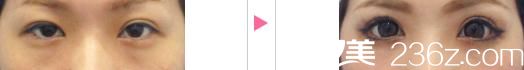 吉原伯切開法雙眼皮前后對比