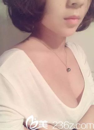 王立英院長做假體隆胸術(shù)后5天胸部微腫