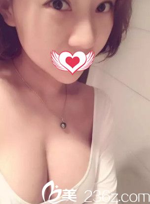 在秦皇島巧致做假體隆胸16天胸部慢慢消腫