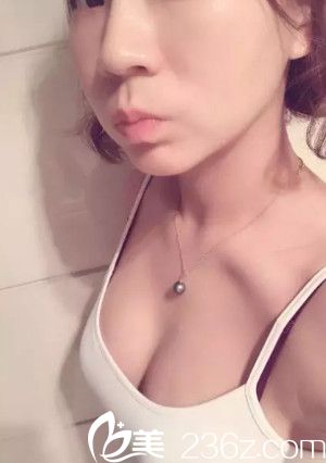 將我2個月前在秦皇島巧致做假體隆胸手術(shù)的親身體驗分享給大家