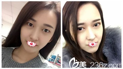 廊坊艾美年末整形優(yōu)惠活動(dòng)正式開啟 雙眼皮888元、吸脂778元