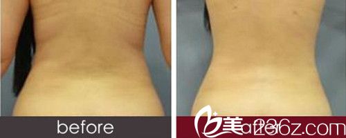 艾美整形醫(yī)院吸脂前后對比