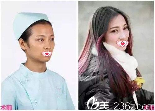 廊坊艾美假體隆鼻案例