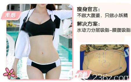 嘉興藝星整形張占召腰腹吸脂案例