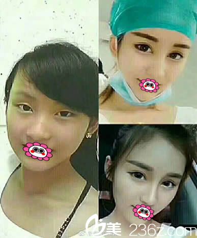 佛山夢(mèng)露孫醫(yī)生切開(kāi)雙眼皮前后變化圖