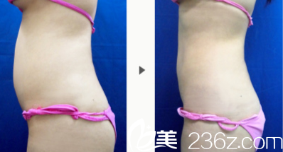 長大庭英信吸脂手術(shù) 長大庭英信吸脂手術(shù)