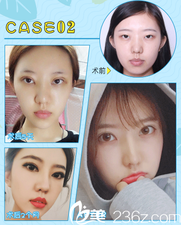 廣州曙光劉志剛做的雙眼皮案例