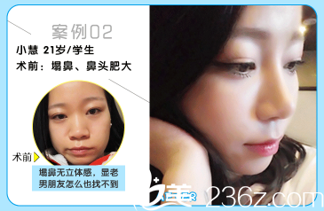 廣州曙光蔣思軍隆鼻案例對(duì)比圖