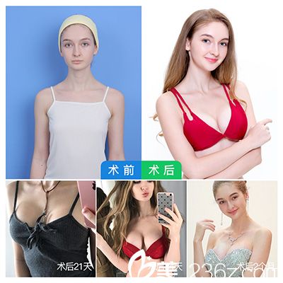 廣州曙光劉杰偉隆胸案例前后對(duì)比圖