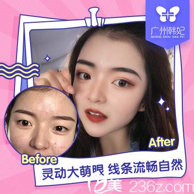 廣州韓妃<!--<i data=20240703-sp></i>-->軍雙眼皮案例圖片