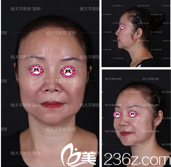 在北京聯(lián)合麗格做高位SMAS提升手術(shù)前樣子 在北京聯(lián)合麗格做高位SMAS提升手術(shù)前樣子