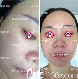 北京聯(lián)合麗格做高位SMAS提升手術(shù)第14天效果 北京聯(lián)合麗格做高位SMAS提升手術(shù)第14天效果