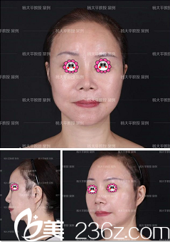 楊大平醫(yī)生給我做高位SMAS提升手術(shù)兩月效果 楊大平醫(yī)生給我做高位SMAS提升手術(shù)兩月效果