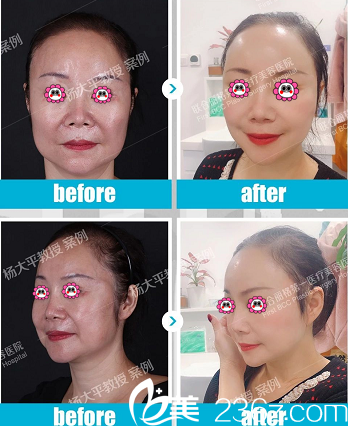 北京聯(lián)合麗格楊大平高位SMAS提升手術(shù)案例 北京聯(lián)合麗格楊大平高位SMAS提升手術(shù)案例