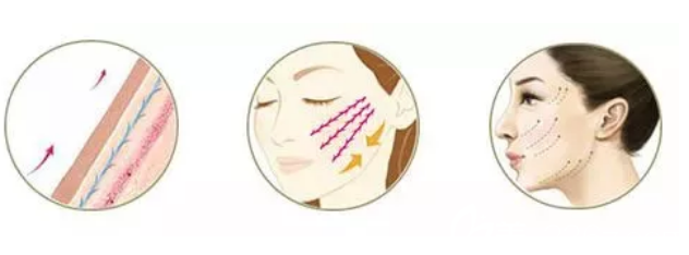 長(zhǎng)春東方年終盛典特惠已開啟原價(jià)34800元全面部線雕提升現(xiàn)12800元