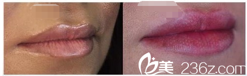 蘇州PPP醫(yī)美2018年底價(jià)目表來襲 部分優(yōu)惠埋線隆鼻2980元脂肪豐唇1188元