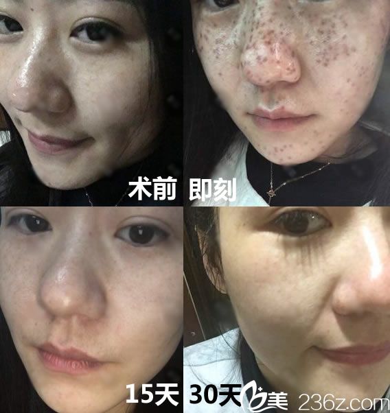 金華張小紅整形杜麗蕓皮秒祛斑<span style= 金華張小紅整形杜麗蕓皮秒祛斑<span style=