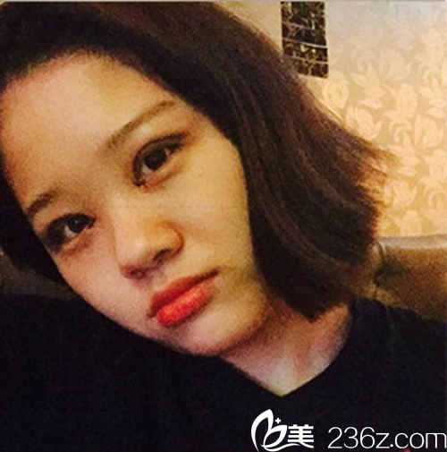 韓國新帝瑞娜（灰姑娘）醫(yī)院眼提肌+雙眼皮+前眼角術(shù)后2-10天