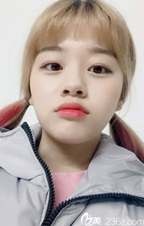 7個月時間在韓國新帝瑞娜（灰姑娘）醫(yī)院眼綜合較終效果圖來了