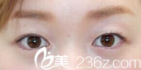 石井秀典埋線雙眼皮前 石井秀典埋線雙眼皮前