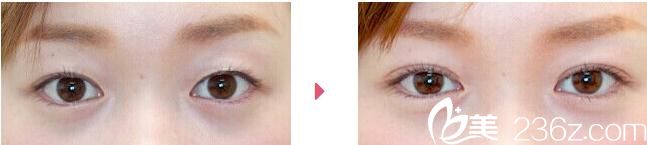 石井秀典埋線雙眼皮前后對(duì)比 石井秀典埋線雙眼皮前后對(duì)比