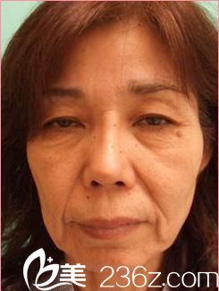 佐藤大介拉皮手術(shù)前 佐藤大介拉皮手術(shù)前