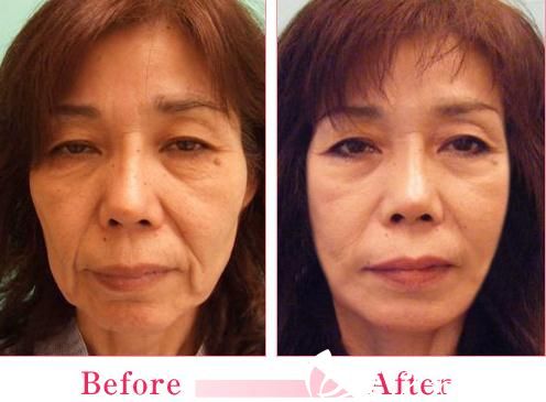 佐藤大介拉皮手術(shù)前后對(duì)比 佐藤大介拉皮手術(shù)前后對(duì)比