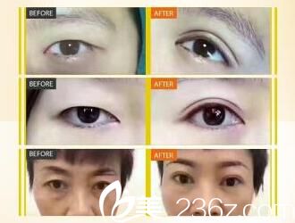 荊門和麗鄭芳蓉雙眼皮案例