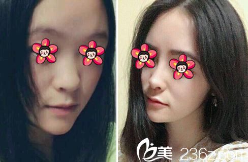 義烏張小紅鼻綜合隆鼻案例 義烏張小紅鼻綜合隆鼻案例