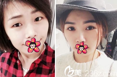 鄧亮醫(yī)生割雙眼皮開眼角案例 鄧亮醫(yī)生割雙眼皮開眼角案例