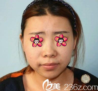 在義烏張小紅整形做隆鼻前 在義烏張小紅整形做隆鼻前