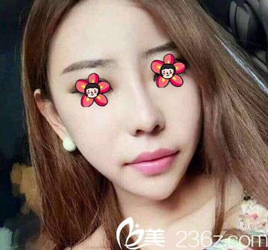 做完鼻綜合隆鼻30天恢復(fù)照 做完鼻綜合隆鼻30天恢復(fù)照